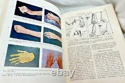 VG+ RARE Surgery of the Hand Bunnell 2nd Edition 1948 Antique Medical Book Illus